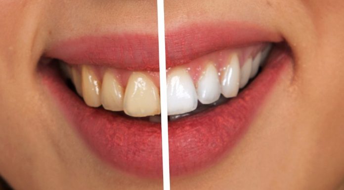 sbiancamento denti